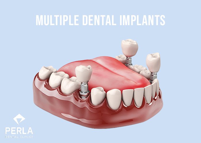Multiple Dental Implants in Turkey What Are Multiple Dental Implants