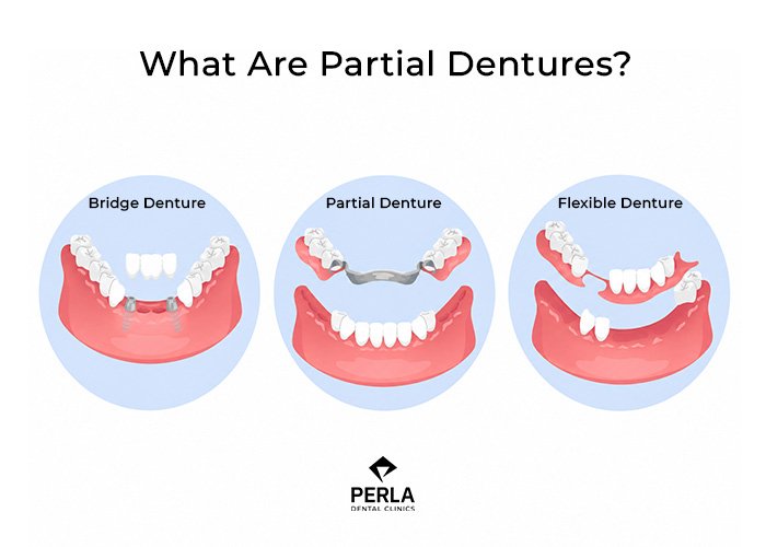 What Are Partial Dentures