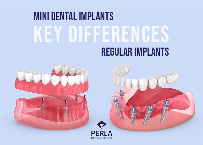 Mini Dental Implants vs Regular Implants Key Differences and Which May Suit You