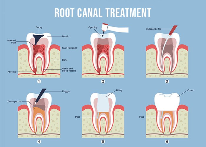 Root Canal vs Tooth Extraction: Which Option Is Better? A root canal treatment steps