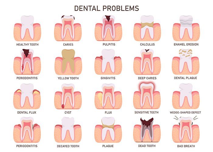 Root Canal vs Tooth Extraction: Which Option Is Better? Common Dental Problems