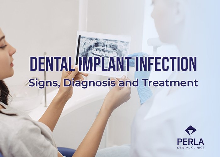 Dental Implant Infection Signs, Diagnosis and Treatment