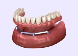 Implant-Retained Denture - What Does Retained Mean