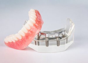 Implant-Retained Denture with four implants
