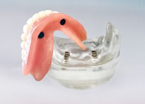 Implant-Retained Denture with two implants
