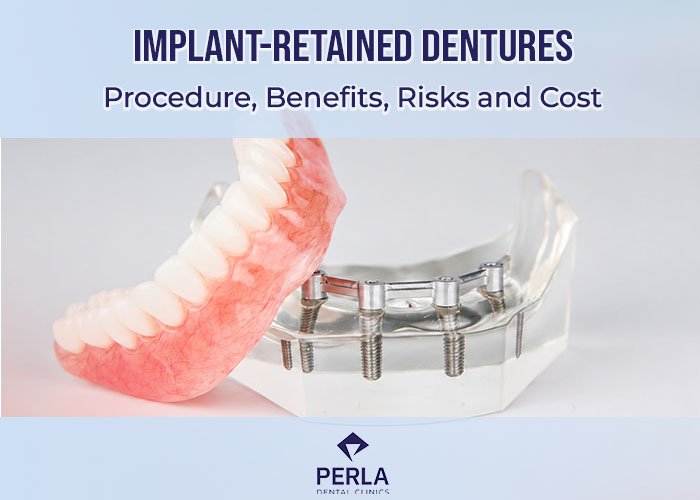 Implant-Retained Dentures: Procedure, Benefits, Risks and Cost Implant-Retained Dentures Procedure, Benefits, Risks and Cost