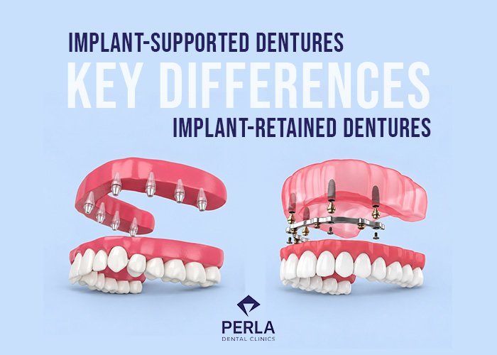 Implant-Supported vs Implant-Retained Dentures: Key Differences Implant-Supported vs Implant-Retained Dentures Key Differences