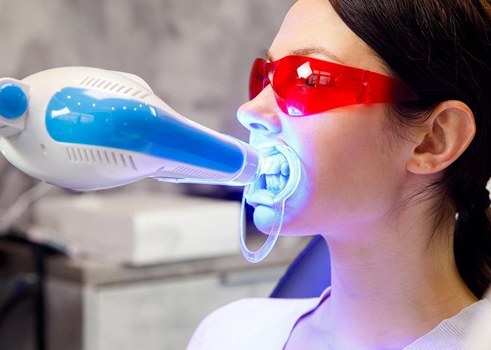 Laser Teeth Whitening Procedure in Turkey