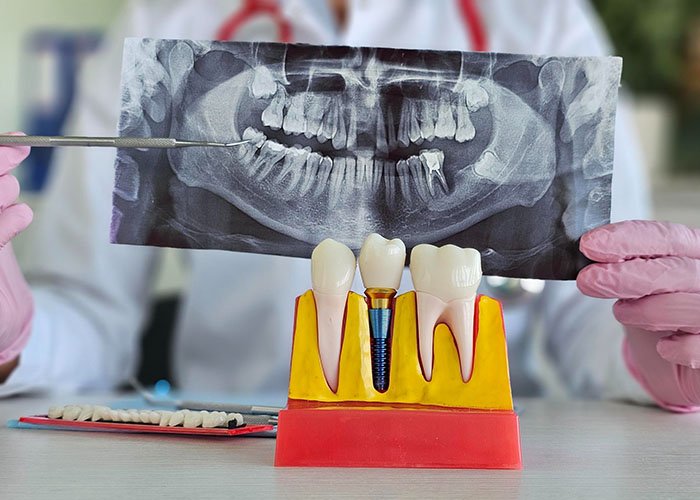 Root Canal vs Tooth Extraction: Which Option Is Better? Replacing an Extracted Tooth With a Dental Implant