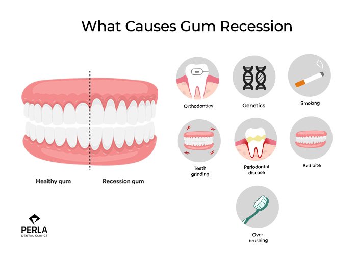 What Causes Gum Recession