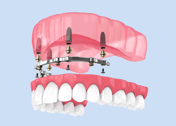What Is Implant-Retained Denture