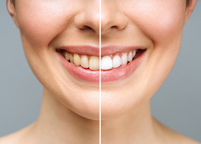 What Results Can You Expect from Laser Teeth Whitening