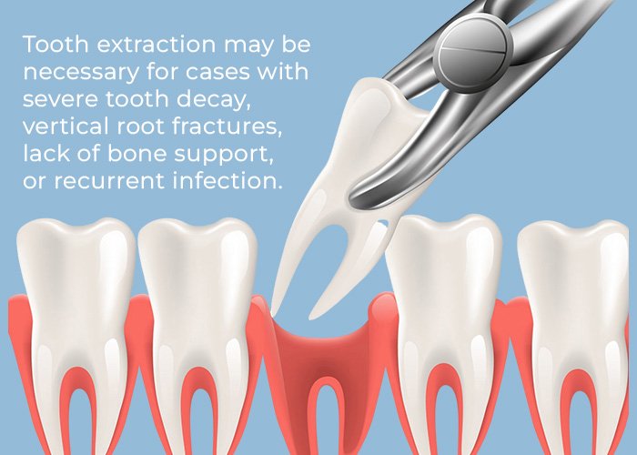 Root Canal vs Tooth Extraction: Which Option Is Better? When Is Tooth Extraction Usually Necessary