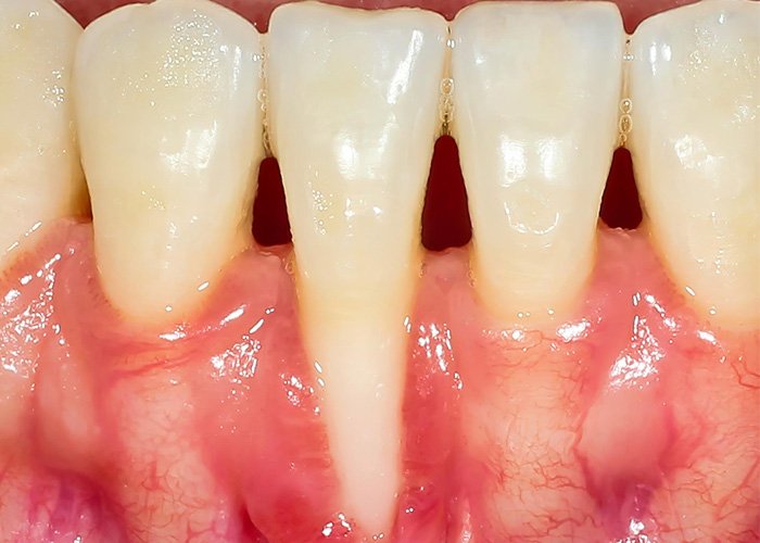 gum margin moves towards the root end of the tooth