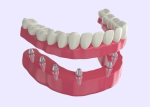implant-supported dentures - What Does Supported Mean