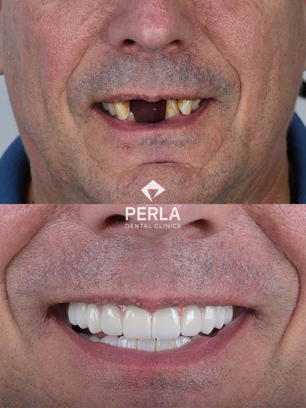 Review All on 6 Implants in Turkey Before After Results​ Perla Dental Clinics Antalya