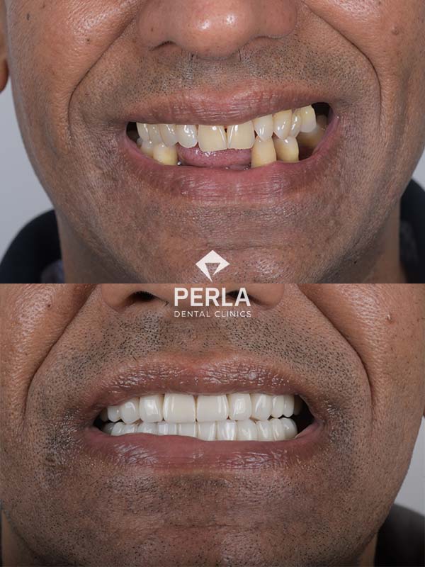 Review All on 6 Implants in Turkey Before After Results​ Perla Dental