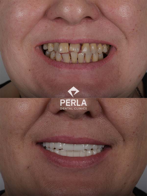 Review All on 6 Implants in Turkey Before After​