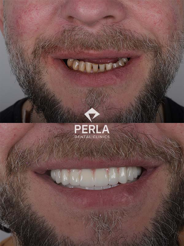 Teeth Implants in Turkey Reviews: Real Patient Experiences Review Full mouth dental implants in Turkey Before After Perla Dental Antalya