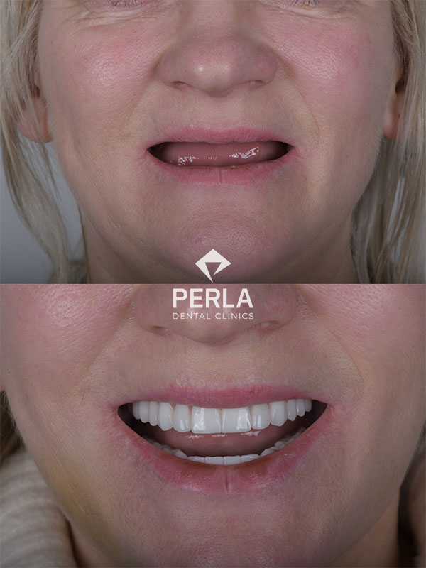 Teeth Implants in Turkey Reviews: Real Patient Experiences Review Full mouth dental implants in Turkey Before After Perla Dental Clinics Antalya
