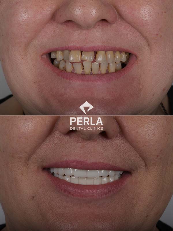 Review Full mouth dental implantsTurkey Before After Results​ Perla Dental