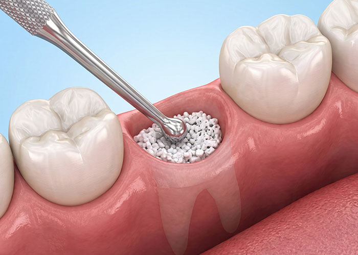 bone grafts may improve jawbone condition